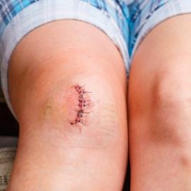 Hegkezelés térden - Floss, FDM, köpöly, tape, tréning